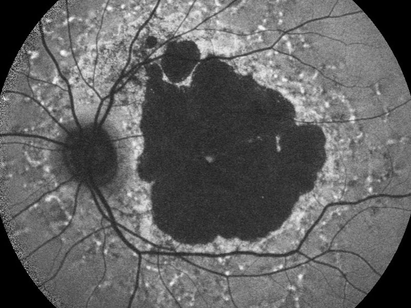 Autofluorescence imaging of an inherited macular dystrophy. Photo by the Nuffield Department of Clinical Neurosciences